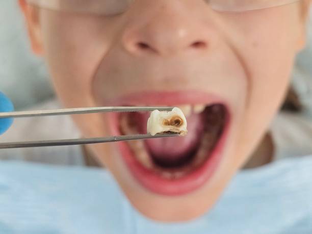 Best Emergency Wisdom Teeth Removal in Magnolia, MS